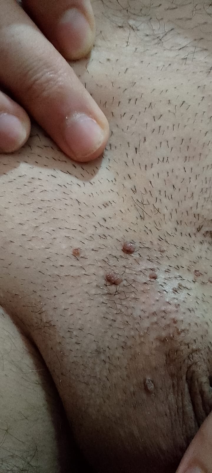 Lyth gjenital (kondilomë) — pamje klinike 5 &mdash; Lytha të shkaktuara nga HPV, të lokalizuara në mons pubis (zona gjenitale me qime). Edhe kjo është një nga zonat që nuk mbulohet nga prezervativi.