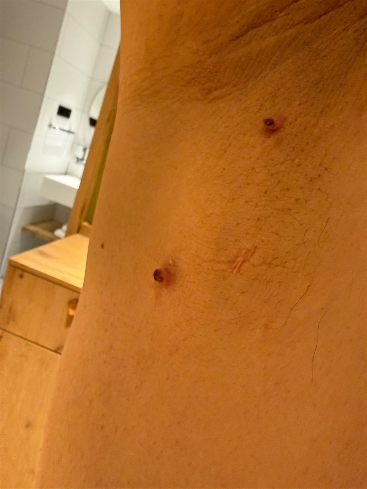 Molluscum contagiosum klinik görüntü 1 &mdash; Molluscum contagiosum lezyonları vücudun her yerinde görülebilir.