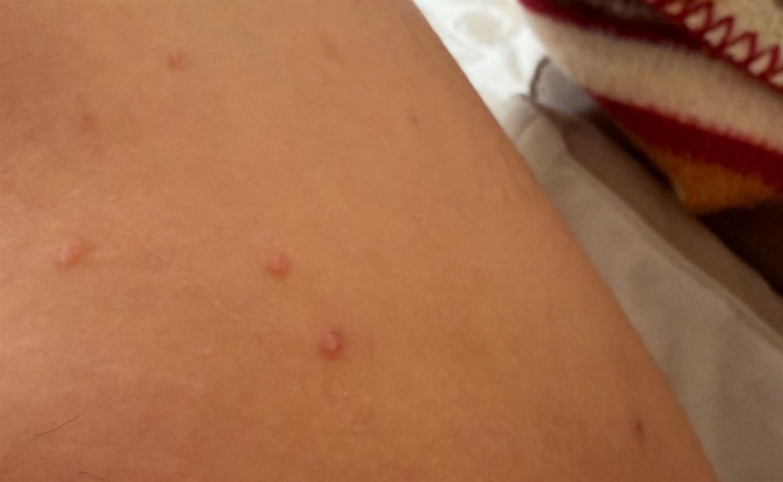 Molluscum contagiosum klinik görüntü 2 &mdash; Molluscum lezyonları siğil, uçuk ve akne ile karışabilir.