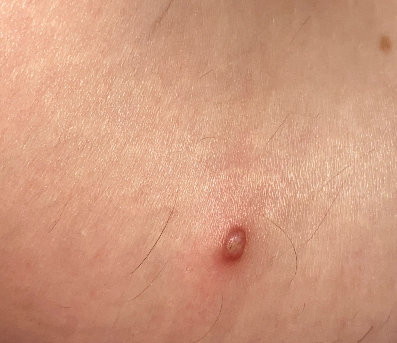Molluscum contagiosum klinik görüntü 3 &mdash; Yüzeyi düzgün, inci gibi parlak, ortası hafif çökük (göbekli) molluscum kabartıları.